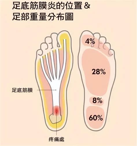 冉冉科普 一踩地就疼的足底筋膜炎，到底是怎么回事？ 哔哩哔哩