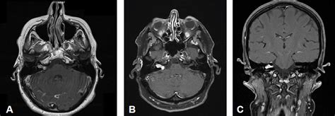 Mri A Axial Initial Findings T Fs Cm Control After Months