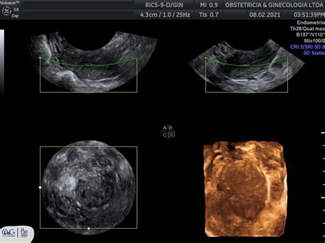 Ecografía Ginecológica
