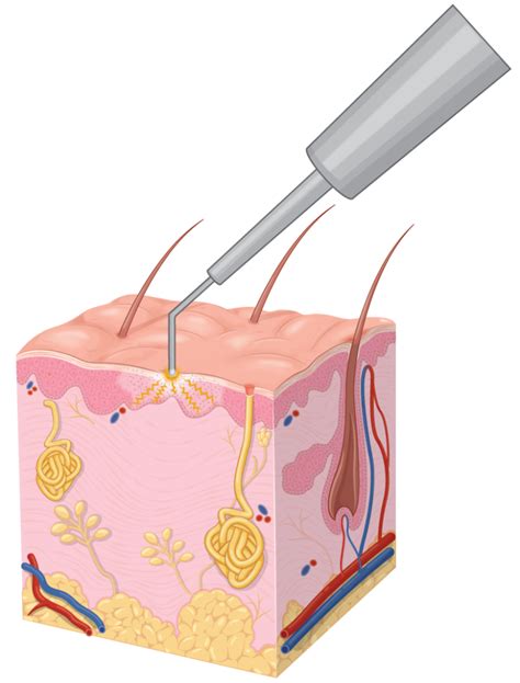 Diathermy For Skin Procedures In Auckland Skintel