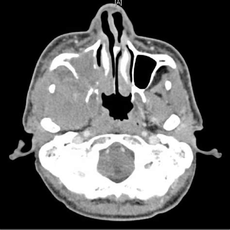Ct Neck With Contrast Soft Tissue Window Axial Cut Showed Soft Tissue