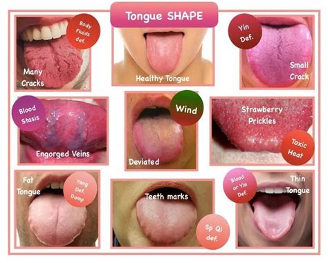 Pin By Jenneke StudioSeiza On TCM Diagnose Healthy Tongue Tongue