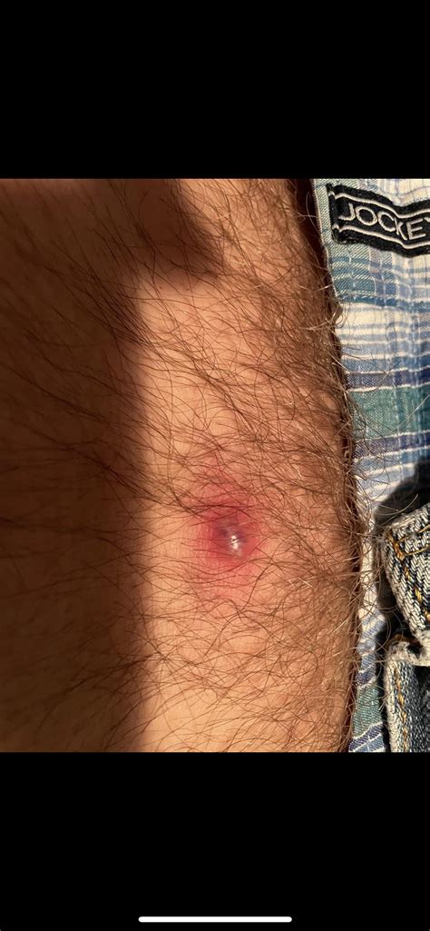 I Believe This Is An Ingrown Hair Cyst How Long Do I Have To Wait Till I Can Attempt To Get The