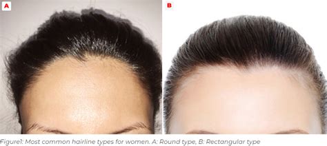 Hairlines Types For Women