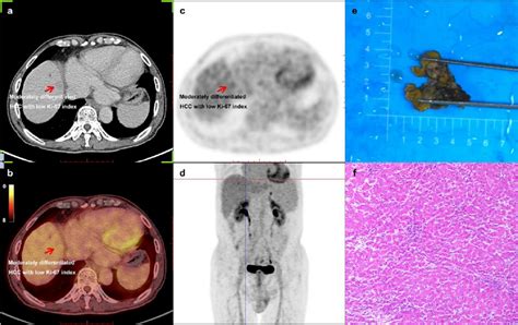 Example For A 70 Year Old Newly Diagnosed Hcc Male Man Detected By Download Scientific Diagram