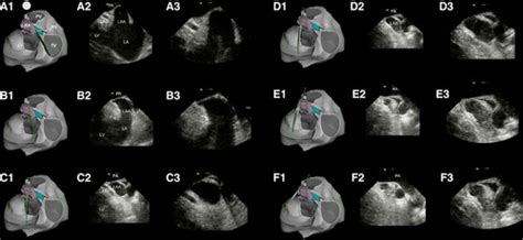 Use Of Intracardiac Echocardiography In Interventional Cardiology