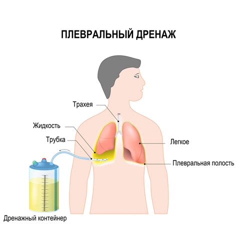 Спонтанный пневмоторакс - причины, симптомы, диагностика и лечение, прогноз