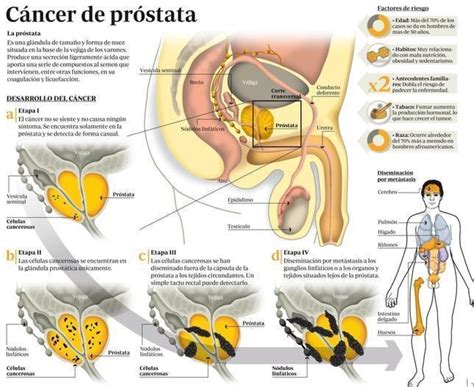 Cancer De Prostata Mapa Mental