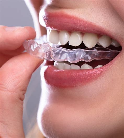 Invisalign Plano Tx Clear Braces Adult Orthodontist