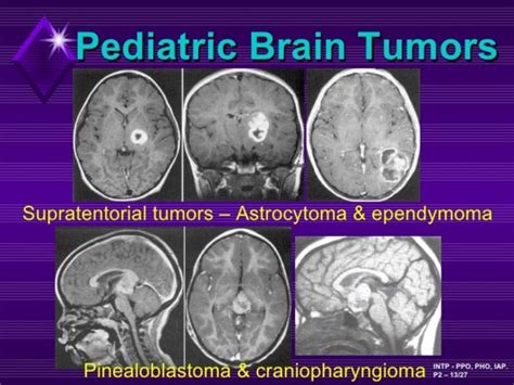 Tumores Cerebrales Pedi Tricos Estudio Proteogen Mico A Gran Escala