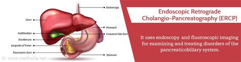 Endoscopic Retrograde Cholangio Pancreatography Ercp