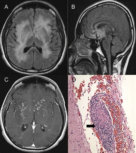 Teaching NeuroImages Diffuse Cerebral Neurosarcoidosis Mimicking