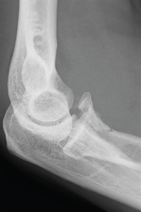 Case 3 Radiograph Demonstrates A Type 2 Coronoid Fracture Download Scientific Diagram