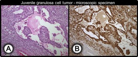 Juvenile Granulosa Cell Tumor Of The Right Ovary A Histological