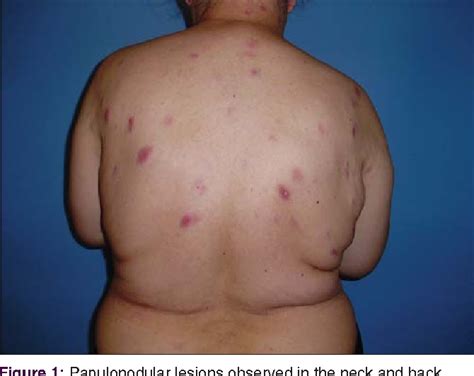 Figure 1 From Primary Cutaneous Follicle Center Lymphoma A Case Report