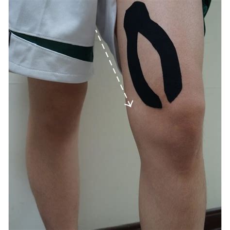 The Applications Of Kinesio Taping For Pfps Patients White Arrow Is