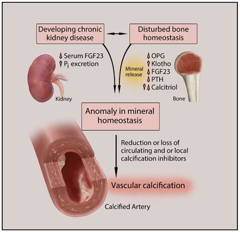 Biomedicines | Free Full-Text | Vascular Calcification in Chronic Kidney Disease: Diversity in ...