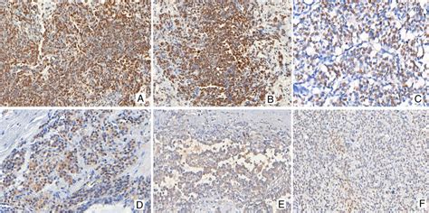 Gli Immunohistochemical Ihc Expression In Gli Amplified And