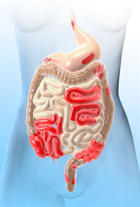 Crohns Disease Surgery In Raleigh Unc Rex Colorectal Surgery