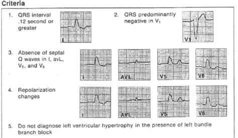 Scvmc Ekg Study Guide Flashcards Quizlet