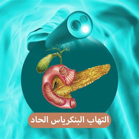 التهاب البنكرياس الحاد أسبابه وأعراضه Dr Mohamed Alboraie