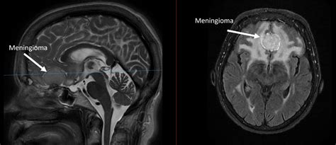 Frontal Meningioma Case Study Prof Brian Owler