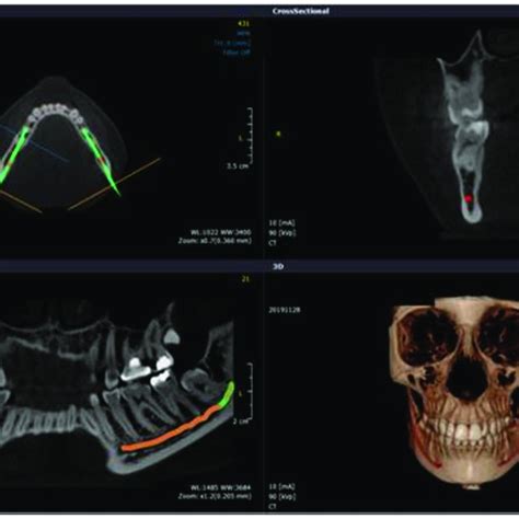 Reformatted Panoramic View On Cbct For Edentulous Mandibular Ridge With