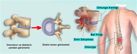 Lumbal Disk Hernisi Bel A R S N N Arkas Ndaki Sebep Bulb