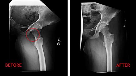 Preoperative And Postoperative Frog Leg Lateral Radiographs Showing The