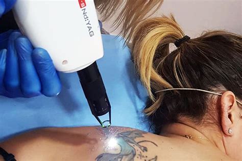 Pautas Verde Traqueteo Laser Yag Para Eliminar Tatuajes Entrada