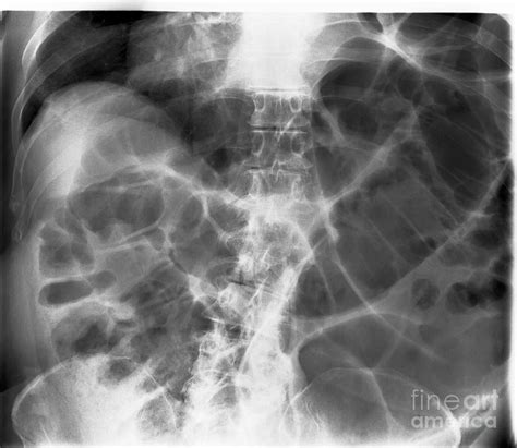 Large Bowel Obstruction X Ray Photograph By Science Photo Library