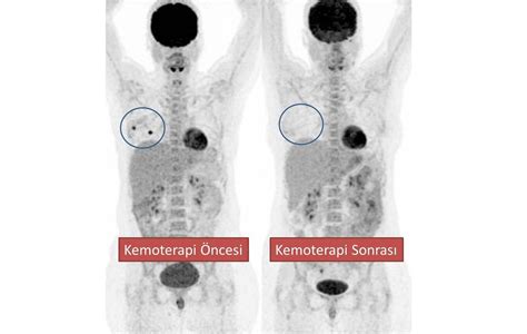 Pet Ct Meme Kanserinde Iyi Gidi At Erken D Nemde Ng R Yor Prof Dr