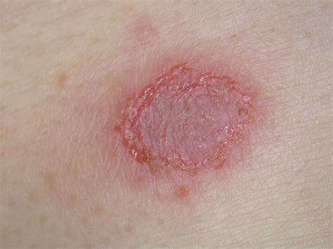 Eczema Dr Jonathan Bowling
