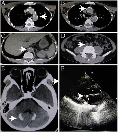 Frontiers Cerebral Haemorrhage In A Young Patient With Atypical