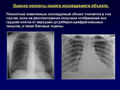 РЕНТГЕНОГРАММА ГРУДНОЙ КЛЕТКИ В НОРМЕ РЕНТГЕНОГРАФИЯ ОРГАНОВ