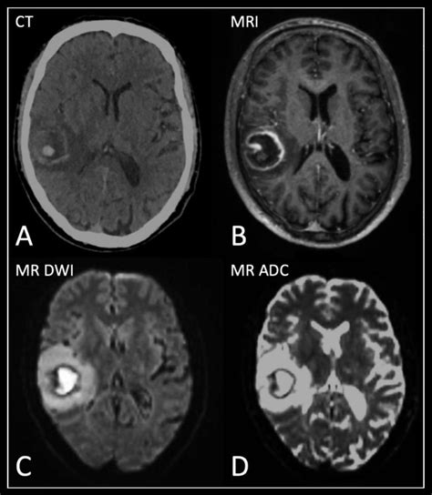 A Contrast Enhanced Computed Tomography Ct Scan And B