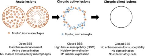Ms Lesions That Smoulder Multiple Sclerosis Research Blog