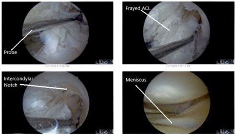 Case Study Chondroplasty Of Left Knee In Yr Old Female