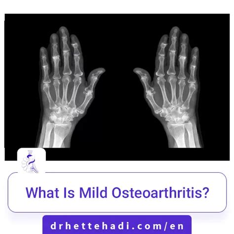 What Is Mild Osteoarthritis Dr Hossein Ettehadi