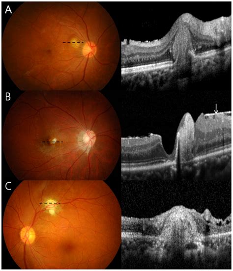 Spectral Domain Optical Coherence Tomography Sd Oct Shows Granulomas