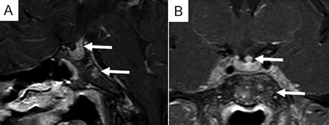 Sella Turcica Magnetic Resonance Imaging Demonstrating Pituitary Gland