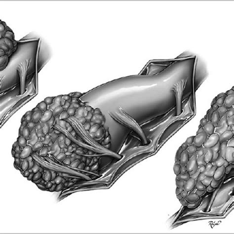 Different types of lipomyelomeningocele. | Download Scientific Diagram