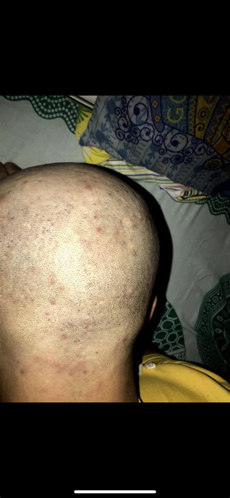 Just Shaved My Head And Found This Could This Be The Cause Of My Hairfall R Malehairadvice