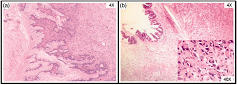 Ovarian Borderline Mucinous Cystadenoma With Anaplastic Carcinoma