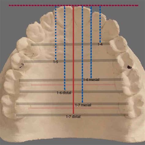 Maxillary Dental Arch Length Measurements Download Scientific Diagram