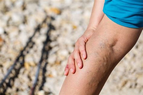 Hidden Health Risks Of Untreated Varicose Veins Njvvc