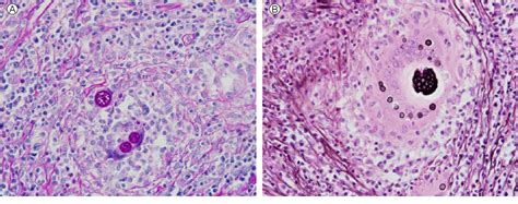 Figure 1 From A Case Of Disseminated Coccidioidomycosis Involving The