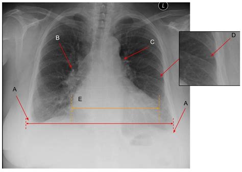 Arm Free Full Text Diagnosing Lung Abnormalities Related To Heart Failure In Chest Radiogram