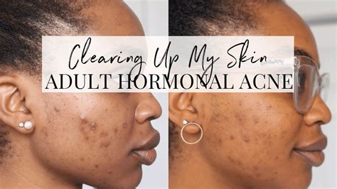 How I Cleared Up Hormonal Acne Skincare Update Youtube