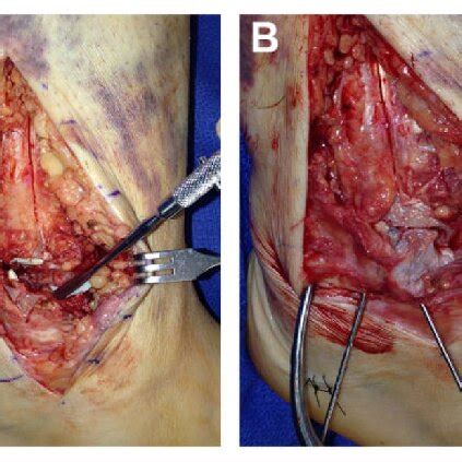 Intraoperative Fluoroscopic Images Showing A The Distal Fragment